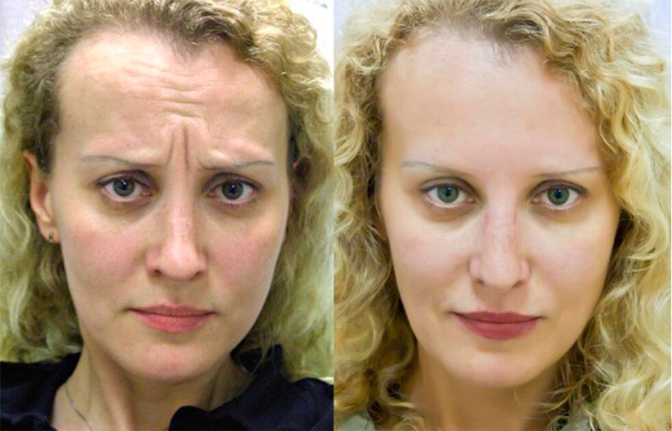 πριν και μετά τη χρήση του μασάζ για αναζωογόνηση ltza photo 1