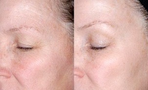αναζωογόνηση του δέρματος γύρω από τα μάτια πριν και μετά τις φωτογραφίες