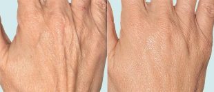 Δέρμα χεριών πριν και μετά την κλασματική θεραπεία