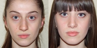 πριν και μετά την αναζωογόνηση του δέρματος στο πλάσμα